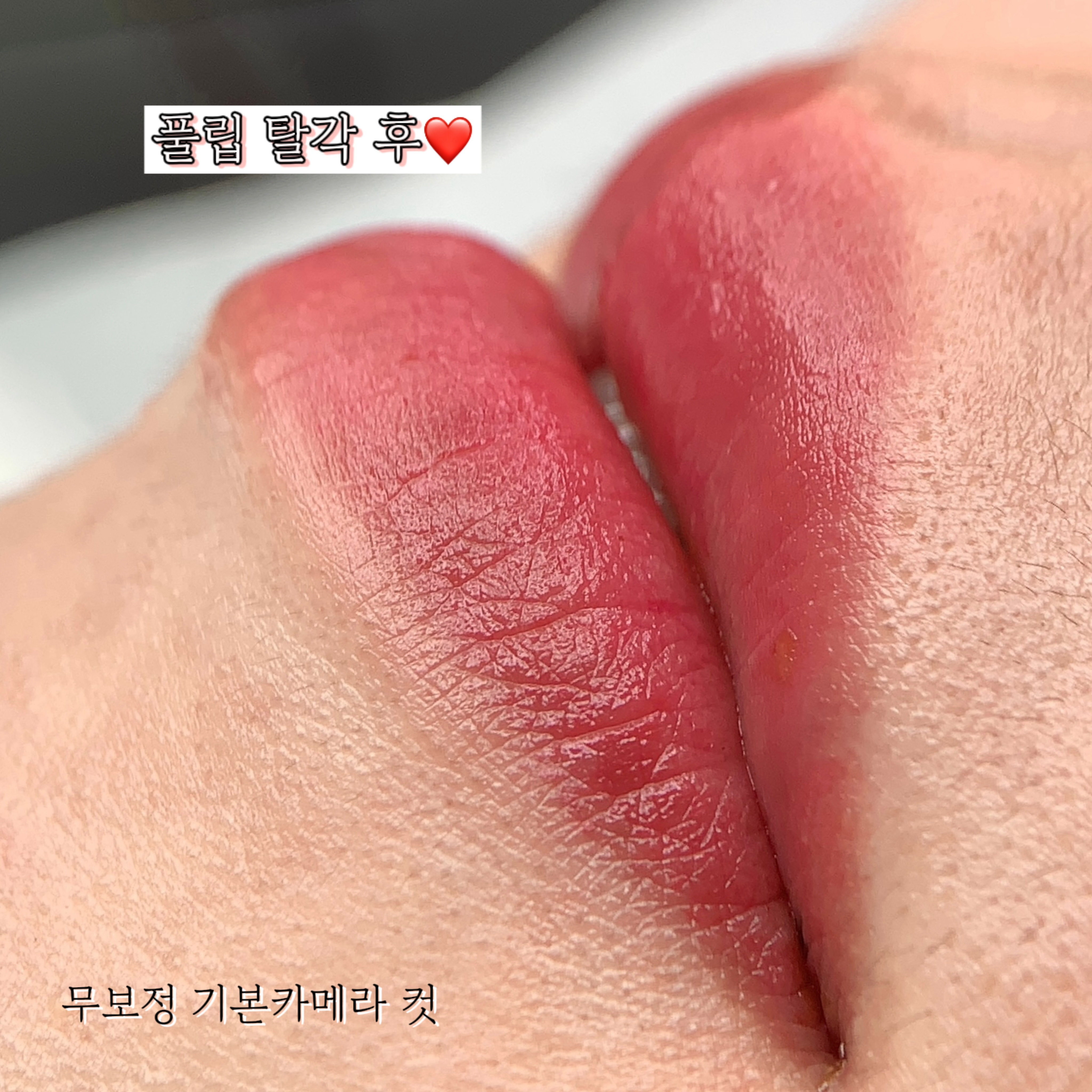 풀립 탈각 후 한달 뒤🔥
탈각 후 남는건 이정도 컬러감이 최고이며
은은하게 그라데이션 넣어도 예쁘지요🤭
입술도 너무 잘하는 민낯쀼티 예지원장에게로 오세용💋