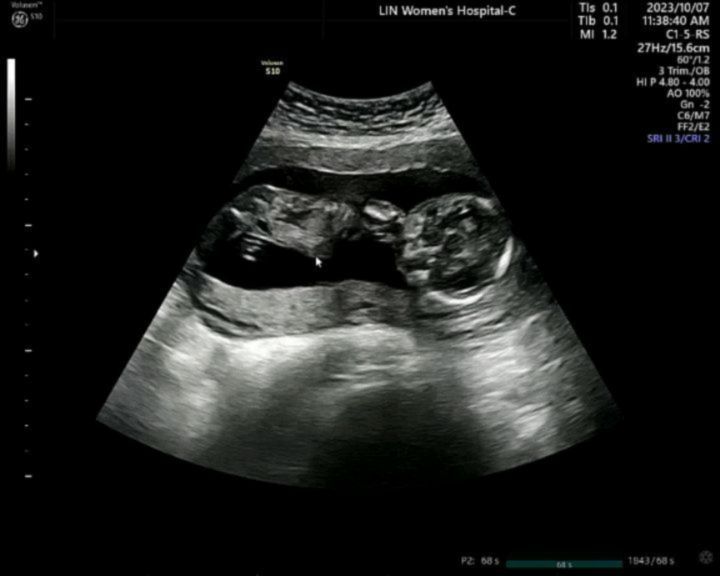 #임신기록
ㅤㅤ

오늘도 역시나 활발하신 둘째님👶
발로도 열심히 찬다는데 아직은 태동안느껴지니..

곧 느껴지게찌..🫶

그리고,

지인들 90%가 아들일거라 확신했던
우리 베리는...!

ㅤㅤ

떠여니의 바램대로
"딸"이랍니다🍓❤️

우리 떠여니는 언니가 되었어요👧

여동생이라는 소식을 듣고 그 누구보다 기뻐했던 첫찌🙂

저역시도 바래왔던 #자매맘 이 되었습니다👩‍❤️‍💋‍👩

ㅤㅤ

#건강하게만나자🫶