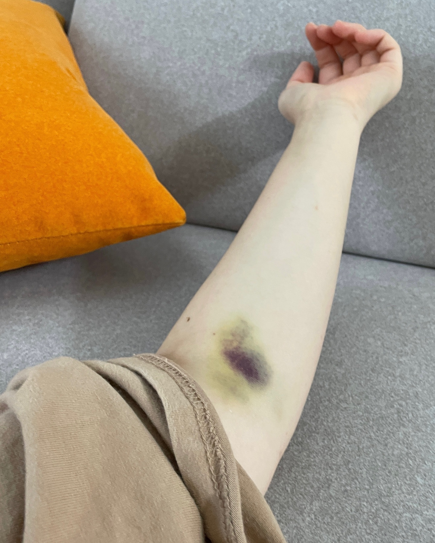 이게맞나…..?

02.15 건강검진 했던 날
바늘 꽂는데 이제껏 피 뽑거나 링거 맞을 때보다 훨씬 아팠던…
(바늘 꽂을 때 혈관이 꺾여있다고 하긴 했음)
3일 지난 오늘 저 상태 🥲

중요한건 저게 아니고
다들 건강검진 하세여 진짜
아직 30대 초반이라서 할까말까 했던 건강검진
오빠하는김에 같이하자 싶어 했는데 검진 끝난 후
결과 들으러 갔는데 대장내시경(수면) 하면서
용종 1개를 제거 했다고 한다

그것도 암으로 가는 선종..🥶
용종 사이즈는 커서 입원 해야된다고 했는데
입원실도 없어서 입원은 패스하고
입원하면서 맞을 주사를 맞고 가라고 해서 다 맞고 집으로..

건강검진 이틀전부터 먹는거 잘 안먹었고
전날도 먹을거라곤 우유 반잔정도
당일에 검진 받으러 가면서 끝나고 뭐먹지? 하면서 갔는데
생각지도 못한 용종제거로 나는 강제금식..ㅎ
마시는것만 마시고 음식은 먹지 말란다 😭

아무튼 내가 지금 하고 싶은말은!!!
건강검진 꼭 하시길…!!
젊다고 방심하지말고 건강하다고 착각하지 말길!