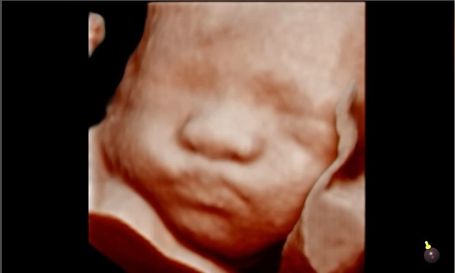 우리 탄탄이 귀여워#❤️ 
얼굴 잘 보여준 우리딸#👼
벌써 1.3키로인 너..#🤰 
아빠가 자기를 닮은거 같다고 엄청 좋아해 
발도 아빠인거 같구나..
나는 자궁만 빌려준거니?건강하게만 나와:) 
#입체초음파#성공#🥰