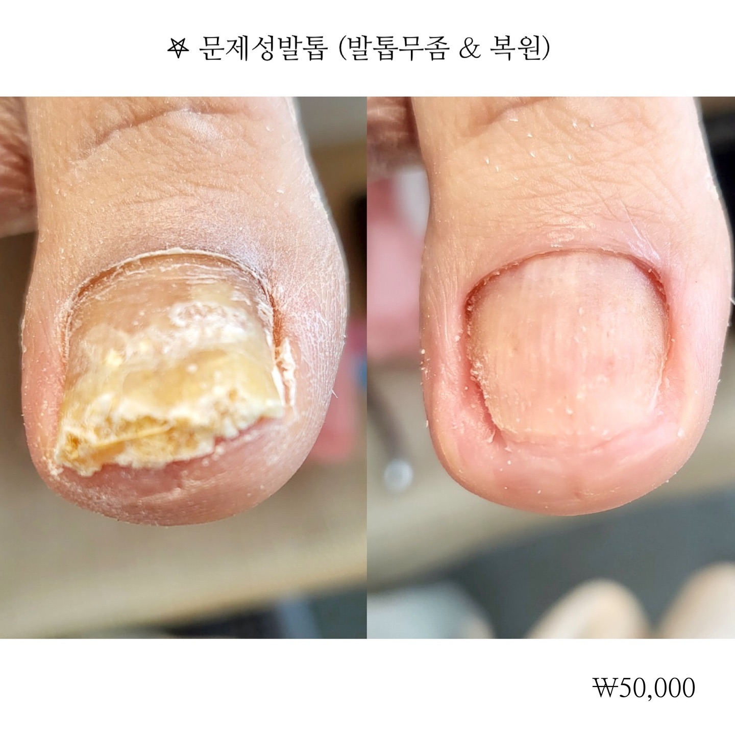 ⠀⠀✦⠀문제성발톱 50,000원
( 엄지발톱 기준 가격 )
#지네일_발톱무좀
-
[ 문제성발톱 전문가과정 수료샵🔖 ] 
-
𖤐 문제성발톱 이란?
질환이나 외적인요인으로 발톱의 변형 또는 발톱무좀이 발생되어 두껍게 자라거나, 표면이 매끄럽지못함, 변색, 악취등 여러가지 증상이 나타나는 발톱
-
한분한분 고객님 발톱 형태에 맞게 통증없이 시술해드려요.
현 상태에 따라 관리주기가 달라져요.
⠀
✓ 시술 상담받아보세요. 남자케어가능
⠀
✧ 시술 100% 예약제입니다.
⠀
⠀