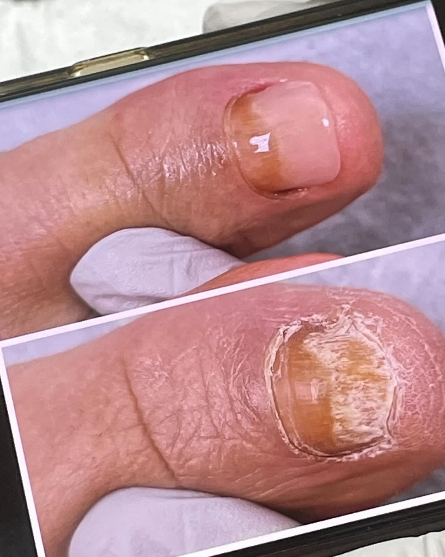 #협찬 대구에서 문제성발톱 내성발톱 무좀발톱 전무케어 가능한 반월당 아토케어 어머니 모시고 다녀왔어요! 의료기관다니시다 아토네일 가봤는데 지난1년 관리보다 만족스럽다고 하셔서 좋았어요~ 1회관리만으로 큰 효과본거 같아서 좋아요 👍