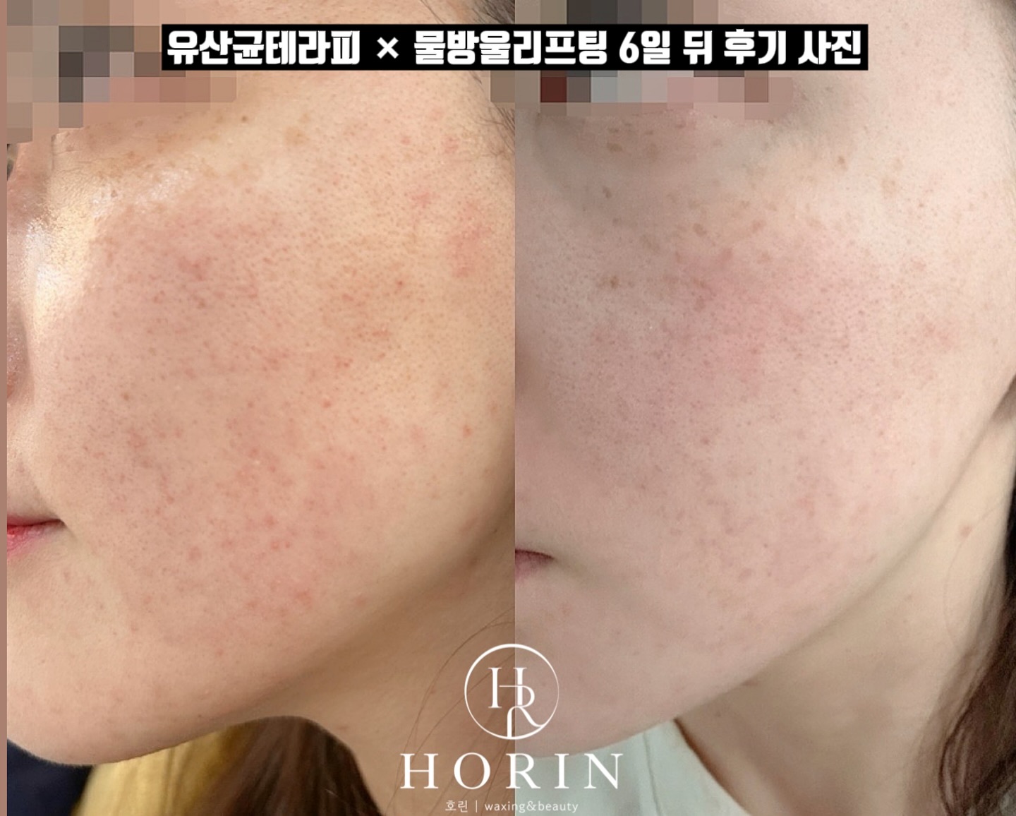 면역력 강화 시켜주는 유산균테라피와 물방울 리프팅의 만남🖤
트러블과 홍조로 신경 쓰였던 피부를 톤업과 피부 장벽강화를 시켜준 세트‼️

피부 절대 지켜 세트가 2월 이벤트로 88,000원 입니다.😎

무너진 피부 장벽으로 고생 하시는분들
먹는 유산균 말고 피부에 양보하는 유산균 하세요 : )

#사가정피부관리 #면목동스킨부스터 #사가정유산균테라피 #유산균나노테라피 #피부장벽강화