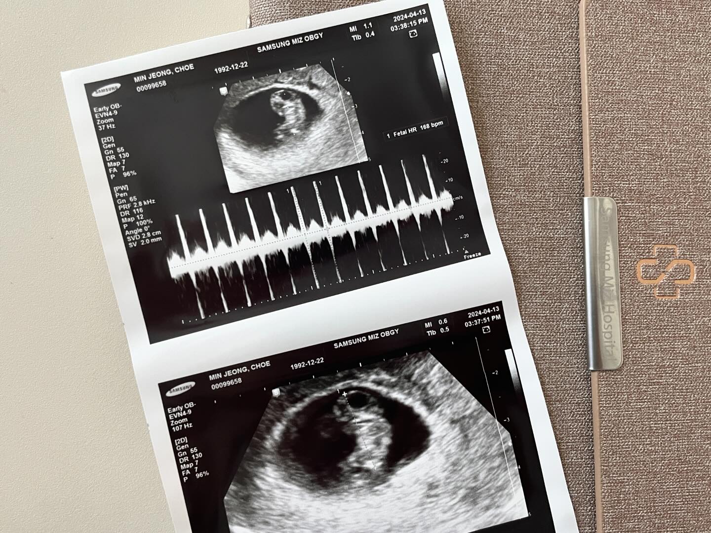 👶🏻 #임밍아웃

내가 이런걸 하는 날이 올줄이야 .. 
한번의 화유와 한번의 계류유산후 다시
뚜둥! 하고 찾아온 혁쩡 베이비 뚜둥이입니다 👶🏻

임신과 출산은 정말 누구도 알수없고 마음대로 할수없는
신비롭고 위대한것이라는걸 올해 가장 많이 느꼈어요 🥹
보란듯이 훌쩍 커준 뚜둥이를 보고와서 기쁜마음으로
임밍아웃 해보기 🤍

이제 모두가 알았으니 건강하게 열달채우고 나오자 💝