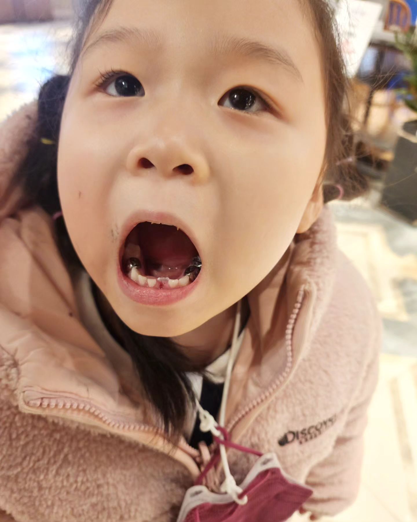 #첫치아발치

오늘 아주~~~ 대단했다.
겁쟁이 우리 막둥이 충치가 심해서 신경치료하고
은니3개나 씌우고 아랫니 영구치가 올라와서 발치하고

겁쟁이가 치과가서 웃음가스 먹어가며 치료하는데
아프다고 소리를 하도 질러서 목이 다 쉬었네~ ;;

그러게 평상시 초코렛, 사탕 좀 그만 먹으라니깐 충치가 심해서
오늘 얼마나 고생했는지..
글고 치과치료비는 또 얼마나 많이 들어가는지~  환장~ ㅋㅋ

앞으로 3개월마다 무조건 정기검진하면서 치아관리해줘야한다고
우리 막둥이 오늘 아주 대단한 치료 했네ㅋㅇㅋ

ㆍ

ㆍ

#구로우리아이들병원 #튼튼치과
