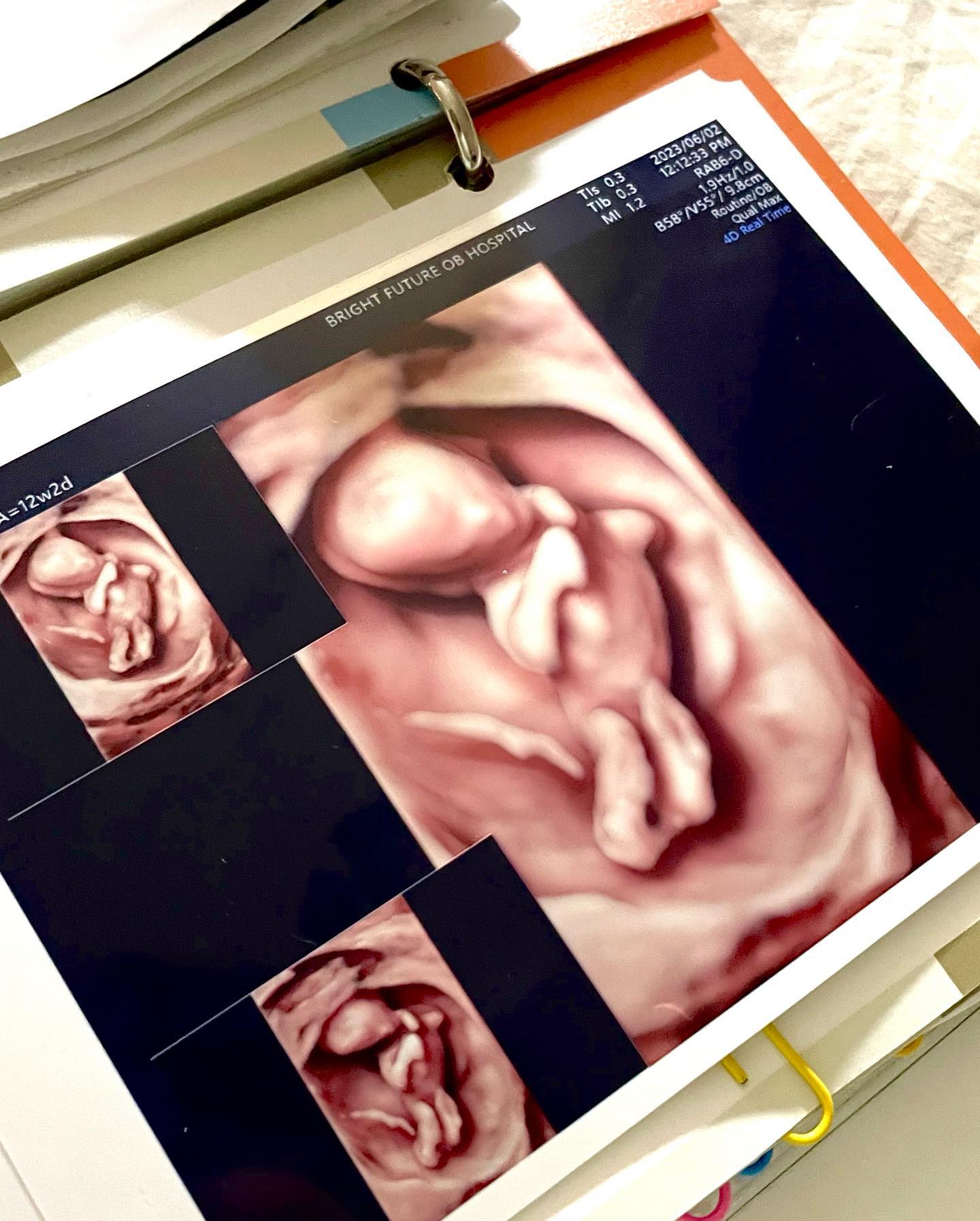 #12w5d👶🏻 
7분 초음파 내내 가만히 있질 않던 우래기
긴 다리 쭉쭉 뻗어가며 존재감 과시하는 🧸

만우절에 존재를 알게되었다고 해서 만우로 이름 지었더니
이름이 마음에 안들었는지 이모 꿈에 나타나
제 이름은 신비라고 알려준 핵인싸 🥶
의견 존중해 신비라고 태명 바꿔드림 🤭

신비야, 건강하게만 나와조
12월에 만나쟈 💜