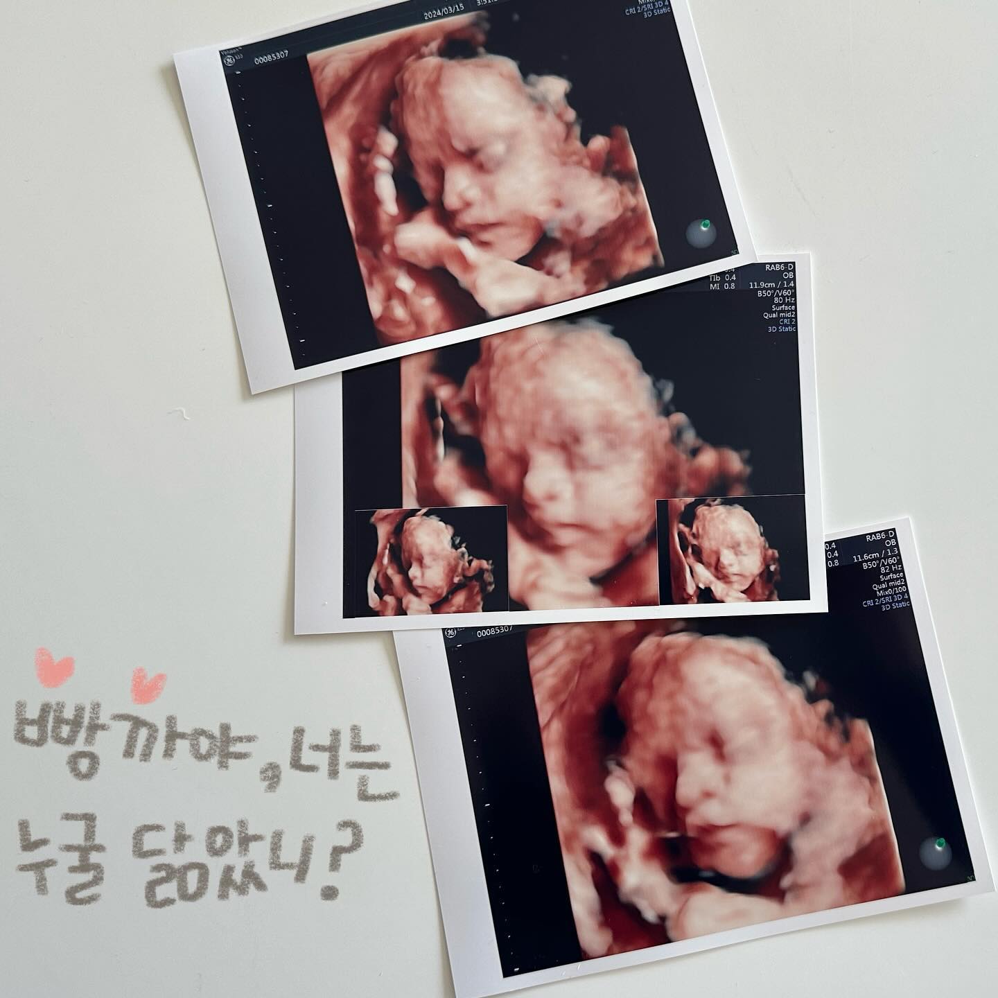 ･ᴗ･
.
“우리 사랑스러운 빵까, 너는 누굴 닮았을까-”
궁금한 마음에 두근대며 초음파실로 찾아갔지만
폴더로 접혀있는 빵까는 발로 얼굴을 가리고있었고
손도 얼굴 옆에 갖다대고선 쉽게 보여주지 않았지
.
걷다오라고해서 열심히 걸었지만 그래도 요지부동이라
의사쌤께서 내 배를 얼마나 흔들어댔는지...그덕분인지
10분도 채 안남기고 얼굴 잘 보여줘서 넘넘 고마웠지💛
.
의사쌤께서 보시더니 누가봐도 아들 얼굴이라고 하셨고
여러 표정 많이 보여줘서 입술내민 모습도 찍혔는데
뽀뽀하는 것 같다고 귀엽다며 얼마나 좋아했는지 몰라
.
초음파로 보이는 얼굴을 마주하는데 왜 나도 모르게
눈물이 한방울 또륵 흐르는지, 정말 신기한 감정..🤍
100일 뒤쯤이면 세상에 태어나 우리 진짜 만날텐데
누굴 닮아도 상관없으니 건강하게만 태어났으면👶🏻
.
#용띠맘 #아들맘 #26주차 #입체초음파
