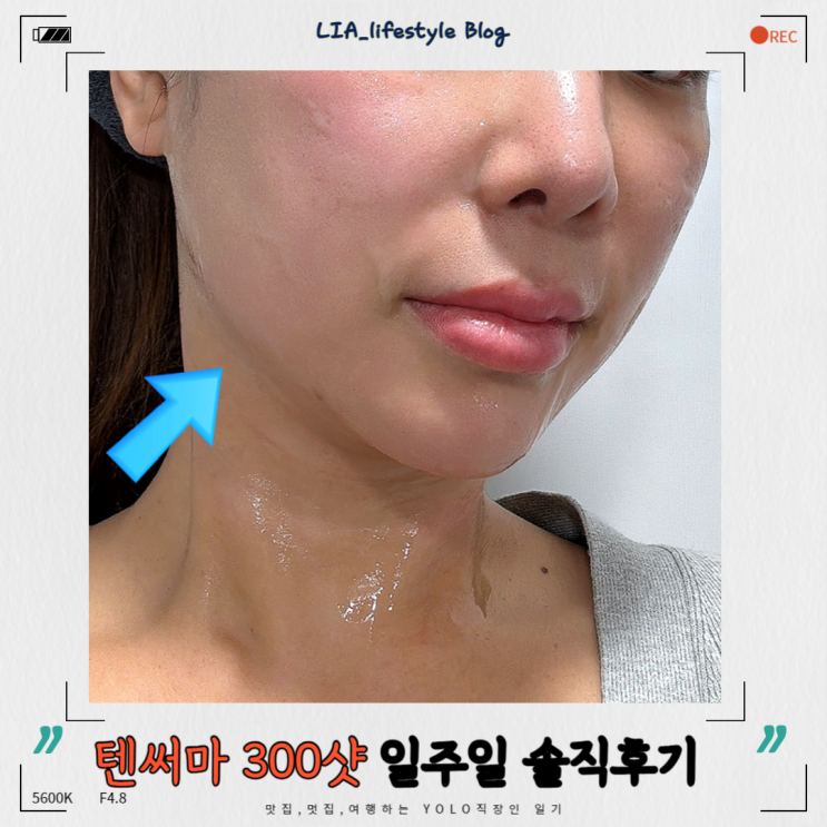 텐써마 300샷 솔직후기 가격과 통증 부작용 정리