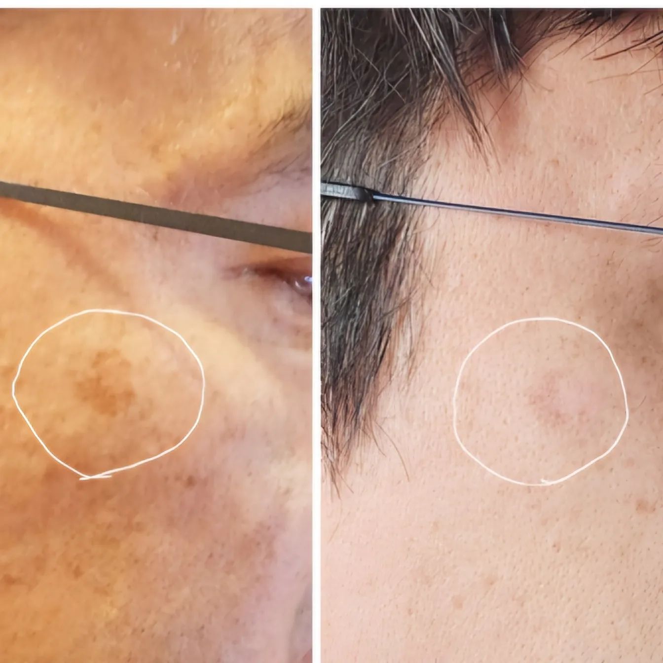 신랑 오른쪽 뺨에 큰 흑자가 색이 점점 깊어져가니 더 나이들어보이고 예전에 일반 레이저치료를 했었는데 다시 올라오더라고요 ㅜㅜ
.
그래서 흑자제거를 알아보다가 1~2회만으로
흑자,검버섯...등 난치성 표피성 색소질환을 제거
할 수 있다는 리팟레이저 받으러 압구정 피부과에 다녀왔답니다 
.
개당 1~2초 이내로 다른 레이저와는 다르게
신랑이 엄청 빨리 나오길래 놀랬어요ㅋ
.
리팟레이저는 식약처 및 미국 FDA승인 받은 의료기기로
치료할 병변 타깃에만 레이저를 조사하는데요!
.
정품 트리트먼트 팁을 사용해 1회성 위생적이고 
안전한 레이저 치료 가능! 
(정품 팁은 QR코드를 통해 확인 가능 하더라고요~)
.
레이저를 받고난 뒤에는 재생밴드 듀오덤을 붙여주는데요
2주간 떨어지지 않고 피부에 붙어 있어야 한다고 해서
내심 걱정했는데 샤워하고 해도 잘 떨어지지 않더라고요

2주후 방문해서 듀오덤 제거후 치료끝!!
1cm가 넘는 큰 흑자인데 1번 시술 전후 신랑이 아주 만족하네요~
.
#백자리팟레이저 
#리팟 #백자레이저 
#검버섯없애는법 
#검버섯레이저 
#손등검버섯 
#얼굴검버섯제거 
#검버섯레이저비용
#검버섯제거비용 
#흑자제거 
#흑자레이저 
#흑자제거비 
#압구정피부과 
#신사동피부과