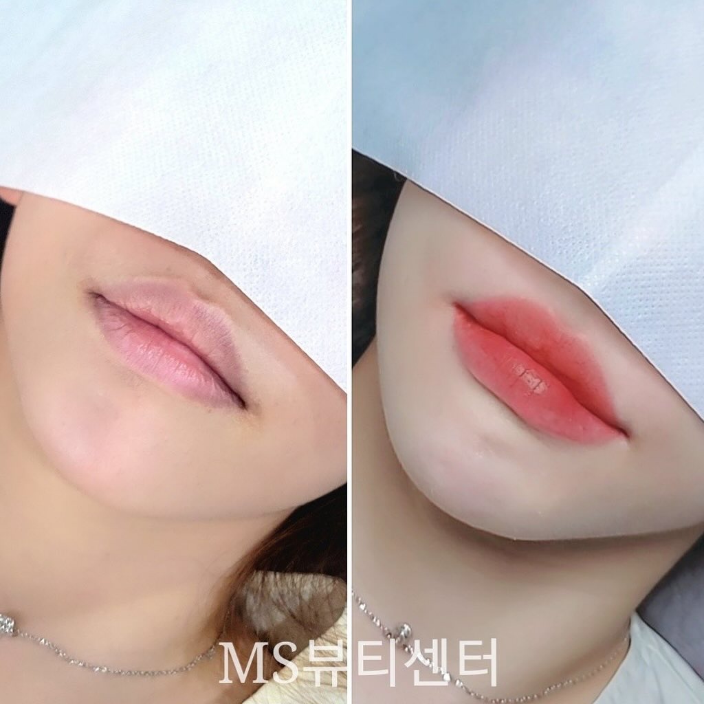 MS뷰티센서 송미선 원장밈 국제심사원하실 정도로 실력파세요! 반영구 같은 경우 한번하면 오래가는 만큼 심사숙고 해서 샵을 결정해야되는데 정말 잘 찾아온거 같아요!🥰🥰 그리고 한번 신규금액으로 시술받으면 평생 리터치 금액으로 시술받을 수 있다는 메리트도 있답니다! 

📍MS뷰티센터
주소 : 서울 강남구 강남대로128길 22
https://naver.me/GJrFvXAc
https://open.kakao.com/o/swK2exib
전화 : 010-5255-0560
.
.
.
#강남눈썹 #강남아이라인 #강남입술 #강남자연눈썹 #아이라인 #눈썹 #입술 #틴트입술 #송미선원장님 #속눈썹펌 수지콤보 #자연눈썹