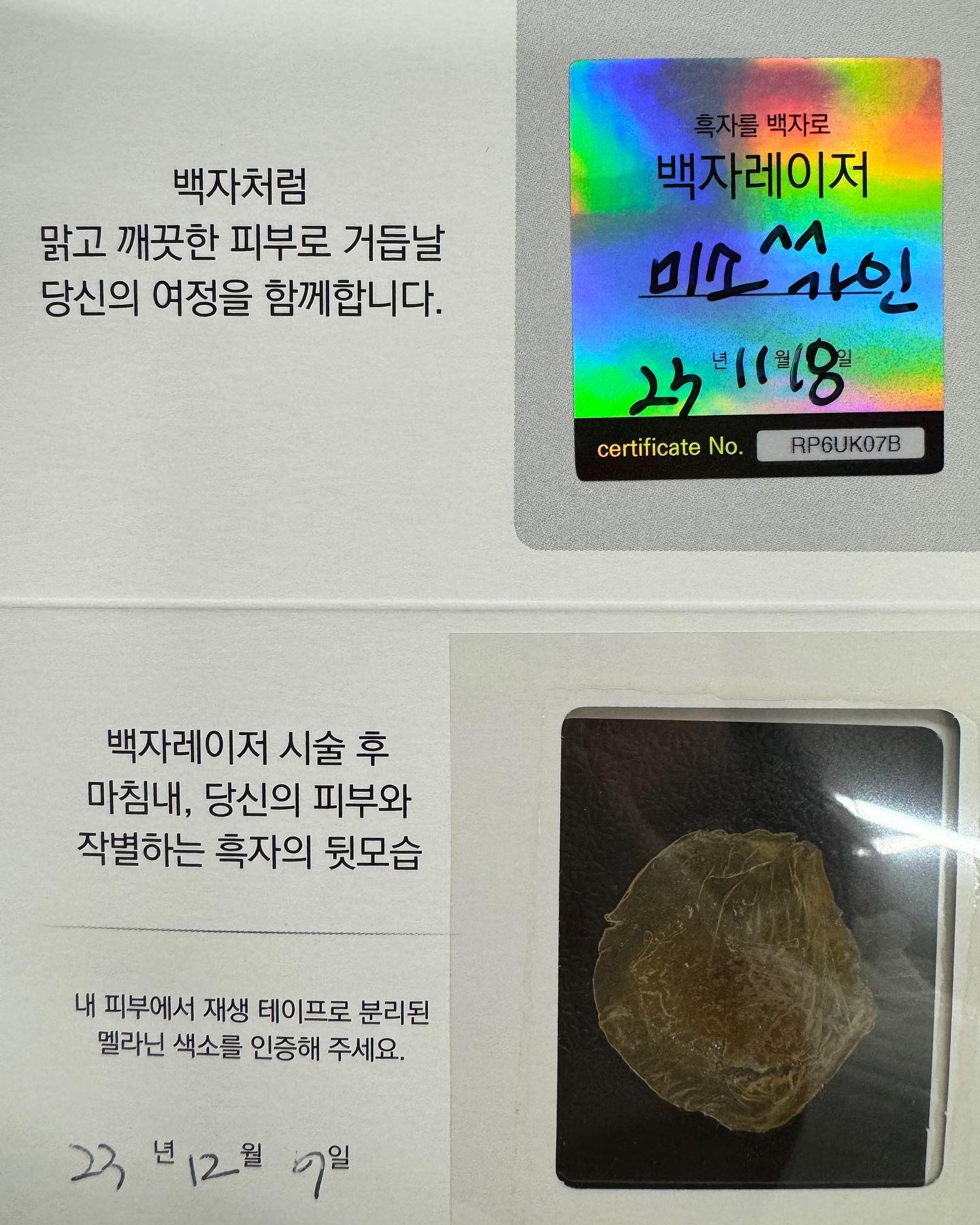 얼굴에 조금씩 있는 기미, 밀크반점 등
색소침착이 스트레스라 내돈내산으로
리팟 백자레이저 흑자 제거 시술을 받았당ㅎㅎ
⠀
다른 레이저 시술은 완벽하게 제거가 안 됐는데
백자레이저로는 완벽하게 흑자가 똑! 제거되어서👍
백자레이저로 말끔히 치료했당➰
⠀
지금 백자레이저 캠페인 하는중이라
저두 이벤트 2차 참여 완료 합니당ㅎㅎ
⠀
색소질환이 고민이신 분들은
피부과 시술 중에 백자레이저 한번 받아보시길!
관심있으신 분들은 백자캠페인 참여 고고🌟
⠀
⠀
⠀
⠀
#이벤트 #캠페인 #피부관리 #백자레이저 #리팟레이저 #리팟 #reepot #백자레이저캠페인 #백자캠페인 #잡티제거 #흑자 #흑자제거