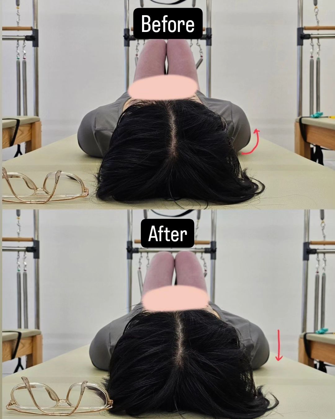 오른쪽 상완골두가 전방, 앞쪽 방향으로 전위되고 어깨뼈가 앞쪽으로 기울어진 케이스입니다

#어깨뼈 의 부리돌기에 삽입되는 소흉근 당김은 어깨뼈를 위쪽으로 돌리고 뒤쪽으로 기울이는 전거근의 효과를 제한시킬 수 있어요 이로 인해 회전근개, 승모근, 능형근의 관계가 변형되어 어깨뼈 움직임에 부정적인 영향을 미치죠 그래서 소흉근은 어깨뼈를 변형시켜 앞쪽으로 기울어진 자세로 당길 수 있기 때문에 어깨뼈 자세 유지에 중요한 역할을 합니다

한 세션 운동 방법🫵
소흉근, 전거근, 상완골두의 전방 전위되는 현상을 막기 위한 안정화 근육으로서 견갑하근 운동에 집중하였습니다 

건강하고 예쁜 #어깨운동 함께 합시다 ✨️