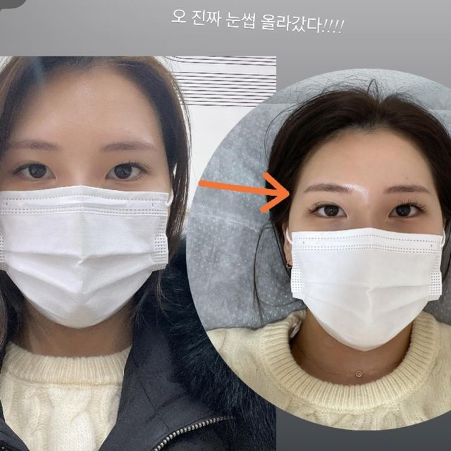 @yun_eevee on Instagram: "#협찬 발바닥 침술로 안면비대칭 치료를!!!? 너무 신기했어요 ㅎㅎ 저는 이마와 눈썹이 무거워서 눈동자가 살짝 덮인 눈에 좌우 비대칭도 있었습니다! 에이 무슨 발바닥