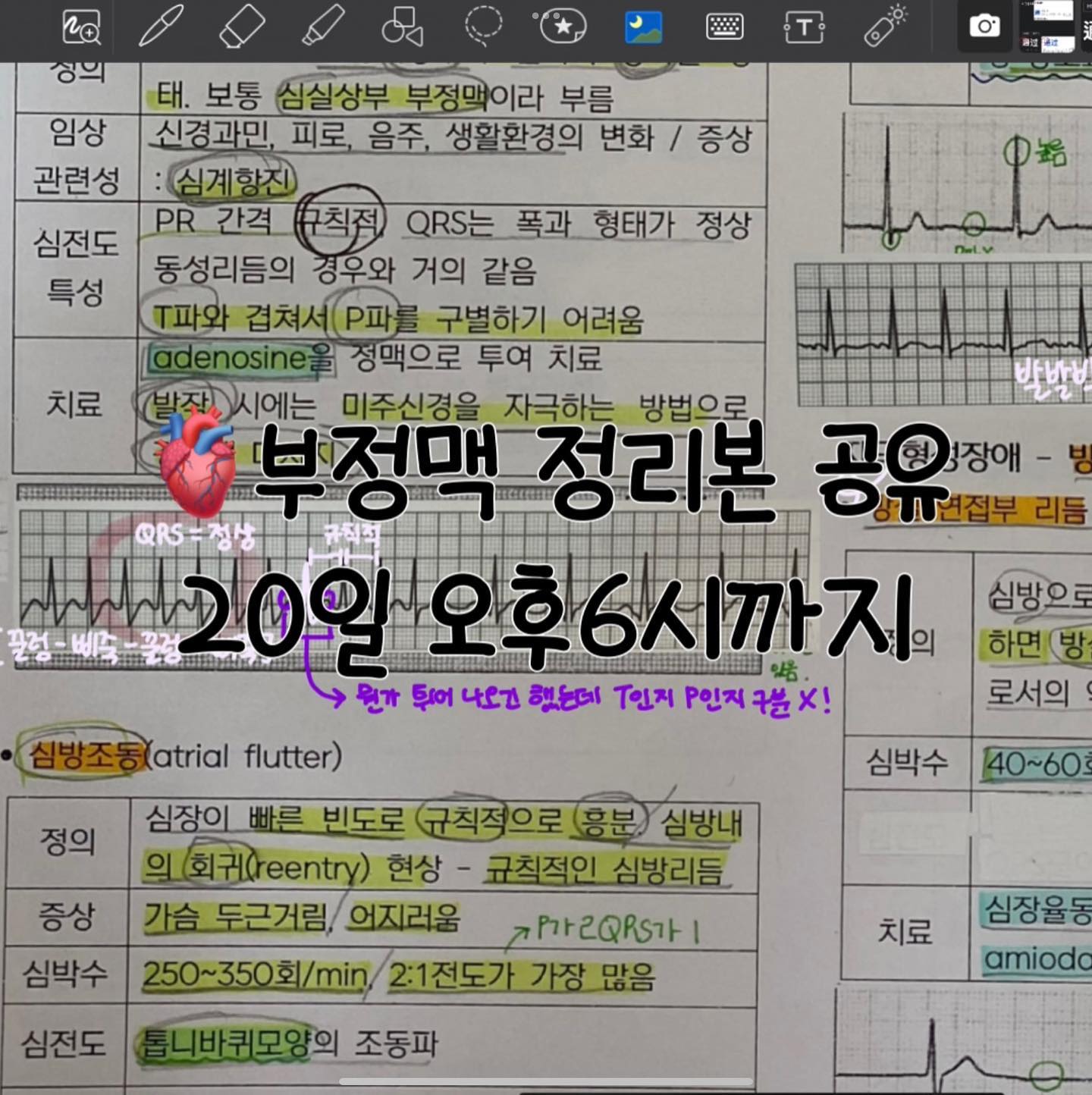 📍📍신청해주신 분이 제 생각보다 너무 많아서 일찍 마감했습니다!!!!!

🫀부정맥 정리본 (pdf)공유🫀
- 국시공부할때 어떻게하면 쉽게 외울까하고 적어봤던 노트에요.
- 제가 필기한거 드리는거라 조금 지저분 할 수도 있어요
- 재공유는 삼가해주세요..
- 제 방법대로 적은거라 부정확 하거나 이해가 안되실 수도 있습니다. 참고만 해주세요!!

⭐️제 인스타 dm으로 이메일 보내주시면 보내드리겠습니다!
📍📍이메일 꼭 같이 써주세요오!!📍📍

(조금 늦게 보내드릴수도 있습니다..!)

📍📍20일 오후 6시까지만 받겠습니다. 그 후는 어려워요!!😭📍📍