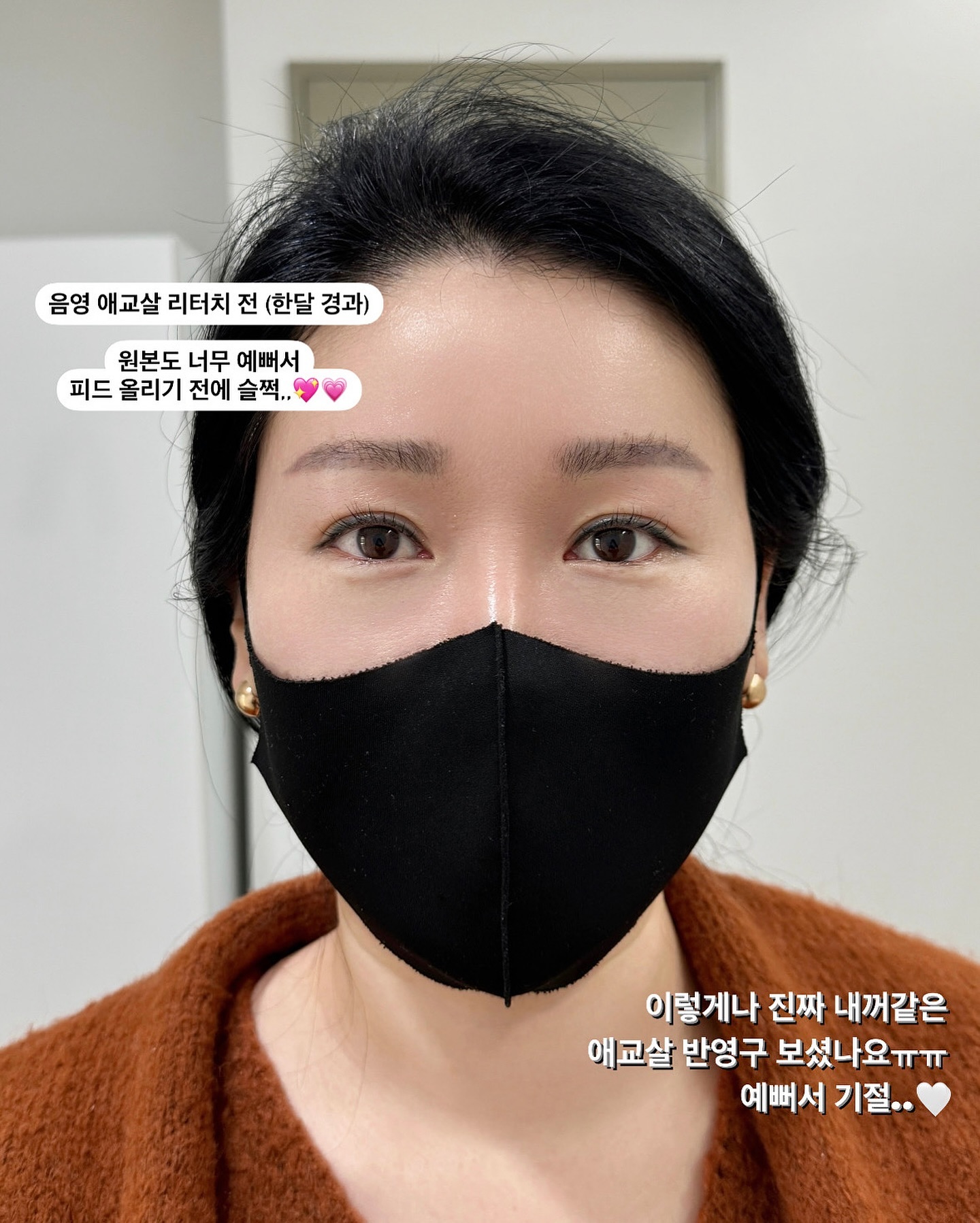 음영 애교살 𝐀𝐟𝐭𝐞𝐫 | 한달 경과, 리터치 전
원본이 제일 예뻐서 원본으로 업로드 ,,🎞️🤎

◾️ 𝘾𝙝𝙚𝙘𝙠 𝙋𝙤𝙞𝙣𝙩 !
☑️ 출혈, 붓기 𝘡𝘦𝘳𝘰 ! 바로 일상생활 가능해요!
☑️ 당일 메이크업, 세안도 𝘖𝘬𝘢𝘺 !👌🏻
☑️ 탈각 기간 𝟮-𝟯일, 𝘋𝘰𝘸𝘯 𝘛𝘪𝘮𝘦🙅🏻‍♀️
☑️ 직후에도 자연스러운 결과물

￣￣￣￣￣￣￣￣￣￣￣￣￣￣￣￣￣￣￣￣
𝟑월 예약 오픈 | 화이트데이 프로모션 진행중
_uneeed 프로필 링크 카카오톡 채널 문의 ✉️

￣￣￣￣￣￣￣￣￣￣￣￣￣￣￣￣￣￣￣￣

𝑈 𝑛𝑒𝑒𝑑-𝑆𝑡𝑢𝑑𝑖𝑜⠀⠀⠀⠀⠀⠀⠀⠀⠀⠀⠀
> 퍼머넌트 메이크업 9년차
> 문제성 피부 관리 10년차
> 미용사(피부) 국가자격증 보유
> 메이크업 국가자격증 보유
> 메이크업 강사 자격증 보유
> 피부지도자 자격증 보유
> 대체요법사 자격증 보유
> 경락사 1급 자격증 보유
> 국제미용기능경기대회 국회의원상 수상
> 국제미용기능경기대회 반영구 심사위원
> 국제미용기능경기대회 피부 심사위원
> 국제바디아트콘테스트 스킨케어 심사위원장
> 국제바디아트콘테스트 메디컬스킨케어 심사위원장
> 국제바디아트콘테스트 반영구 수석 심사위원장
> 국제바디아트콘테스트 반영구 글로벌 심사위원장

⠀⠀⠀⠀⠀⠀⠀⠀⠀⠀⠀⠀⠀⠀⠀
⠀⠀⠀⠀⠀⠀⠀⠀⠀⠀⠀⠀⠀⠀⠀
#애교살반영구 #애교살 #애교필러 #음영메이크업 #산본반영구 #산본눈썹문신 #산본애교살반영구 #산본애교살 #범계애교살반영구 #안양애교살반영구 #수원애교살반영구 #음영반영구 #반영구교육 #반영구후기