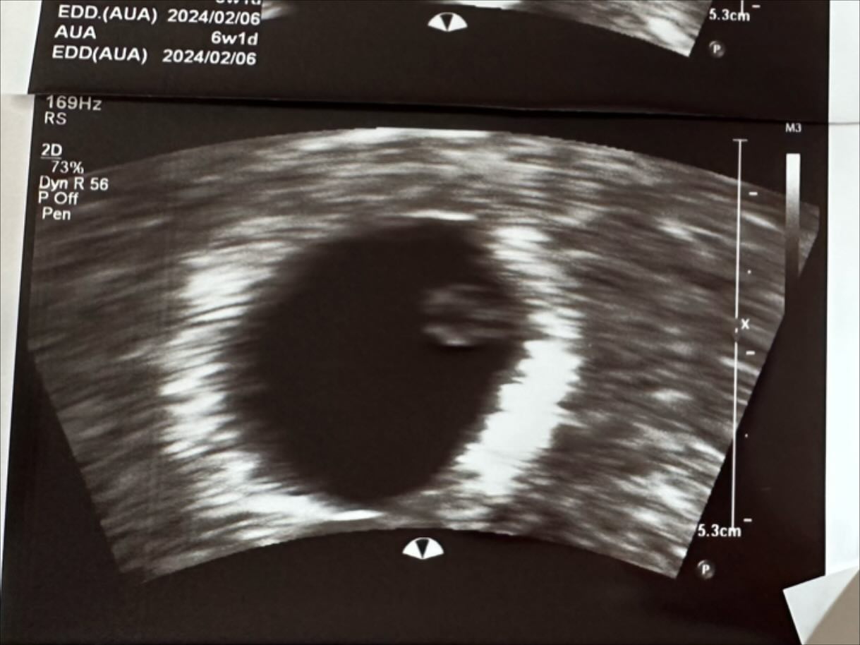 우리 꼬맹이 처음 엄마아빠한테 찾아와주던 날부터 하루하루 만날날을 손꼽아 기다렸단당👼 ❤️

세상에 예기치못하게 우리 아기가 찾아와줬는데 혹시라도 너무 부족한 엄마아빠로 만나게되면 어쩌지하고 걱정되는 마음도 들었지만… 그만큼 너무 반갑고 소중한 마음이 얼마나 컸던지🥹

처음 너의 존재를 알게된 날 엄마도 너무 행복했지만 아빠는 또 얼마나 행복해했는지 몰라 ~ 아직도 그 표정과 웃음이 잊혀지지가 않네 ☺️ 

너무 행복한 일을 주변에 알리면 혹시라도 그 행복이 도망갈까봐 그게 무서워서 아주 조금만 우리만의 비밀로 알고있자고 했지만 .. 행복에너지라는게 말을 하지 않더라도 주변에 전해지는 거더라구 ! 😇 다 우리 꼬맹이가 알려준 일이야 ❤️ 

너를 조금이나마 더 보고싶어서 병원을 찾아가서 초음파 사진도 찍어보고 심장소리도 들어보면서 기다렸던 시간들이 아직도 엊그제같은데 , 벌써 이렇게 엄마아빠 품에 포근히 우리 아기천사가 안겨있네.. 최고의 선물 ~ 넘 고맙고 사랑해 🥰❣

#포미즈여성병원 #정철 #부원장님 #쉬는날 #출근 #응급제왕 #넘감동 #로케 #탄생 #환영합니다 👼 
formiz_womens_hospital