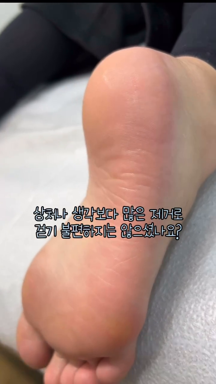 발각질 보기 싫으셔서 셀프로 관리
하고 계신분들 주목 해주세요‼️

셀프로 어떻게 발각질을 제거 하실때
도구를 사용해서 많이들 사용하실꺼에요
전용 블레이드나 드릴을 사용 하시는데 

발 각질을 제거하는 과정에서 너무 강하게 긁어내거나 날카로운 도구를 사용하면 피부를 손상시킬 수 있습니다. 이로 인해 상처, 염증, 감염 등의 문제가 발생할 수 있습니다.

발 각질을 셀프로 제거하면 전문가가 하는 것만큼 효과적이지 않을 수 있으므로 첫 관리는 전문가에게 맡겨주시고 집에서 각질 제거제로 가볍게 제거 후
바셀린 + 풋 크림으로 관리해 주시면
더욱더 효과적으로 관리 가능하답니다 🖤

단순 각질만 있는게 아닐 수 도 있어요!
꼭 전문가에게 상담 받고 안전하게
각질제거 해보세요‼️😎

#사가정패디플래닝 #사가정발각질제거 #면목동패디플래닝 #발각질제거 #패디플래닝수강 #신내동패디플래닝 #망우동패디플래닝 #셀프관리