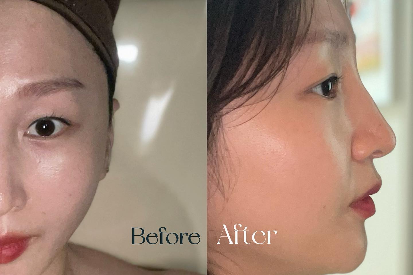 울긋불긋 예민해진 피부와
모공속 묵은 각질로 고민이었는데 
아쿠아 필링으로 노폐물이 쏘옥~

기기관리와 수분보습 및 
종합적인 피부관리 덕분에
맑고 투명한 피부로 자신감 up

쫀쫀한 모찌피부로 탄생했네요
만족도 굿굿입니당!

📍천지빛깔
서울 동작구 동작대로 25 사임당화장품 빌딩 2층

#천지빛깔에스테틱 
#사당피부관리#문제성피부관리#일인룸#체형관리#메디컬기기관리#여성피부관리#남성피부관리#림프관리#천지빛깔#일상#좋반#좋아요그램