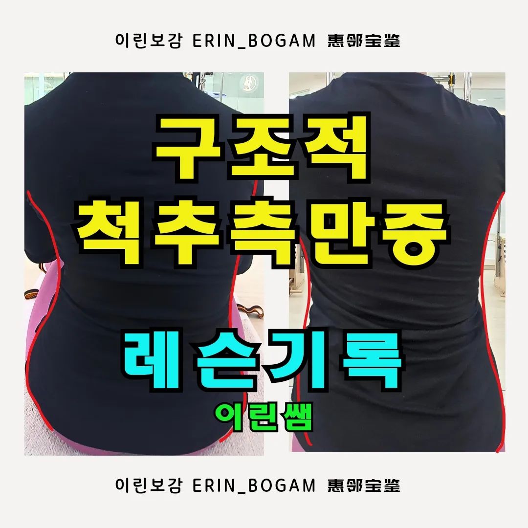 흠, 이번주도 여러케이스 보느라 고생했다 나자신.

1. 요즘 가장 많이 보는 케이스 TOP5 는 #척추측만증
#척추측만증 은 구조적인 부분도 있고 그렇지 않은 경우도 있고
겉은 부드럽고 속은 딱딱한 겉부속딱 형태의 측만도 있고
겉도 딱딱하고 속도 딱딱한 겉딱속딱 형태의 측만도 있다.

2. 구조적 척추측만증이다보니, 각도가 굉장히 크게 틀어져있으며
운동을 하고, 하고나서의 차이가 분명 있지만
집에서의 개인관리가 들어가지 않는다면 금방 돌아오기도 한다.

3. 성인에 비해 학생일 경우 더 그렇더라.

4. 어쨌든 운동 10회릉 진행했고 사실 너무 바쁜 스케줄탓에 주 1회의 운동밖에 진행하지 못했지만 운동 전후로의 차이는 보인다.

-> 체형에 필요한 호흡을 지속하고,
-> 견갑대움직임을 만들고, 
-> 발에 대한 인지를 통해 관절의 움직임리듬을 만들고,
-> 재미와 공감대를 통해 사람과 사람간의 신뢰를 쌓고.

5. 몸은 역시 꾸준함이 답이다.

#운동기록 #레슨기록 #척추측만증 #척추측만증운동
#대구필라테스추천 #이린쌤레슨후기 #이린쌤레슨기록
#해부학강의 #대구해부학교육 #대구필라테스강의
#대구척추측만 #대구척추교정 #척추측만증 
#청소년척추측만 #성인척추측만 #scoliosis 
#脊柱侧凸 #脊柱侧弯 #pilates #韩国普拉提