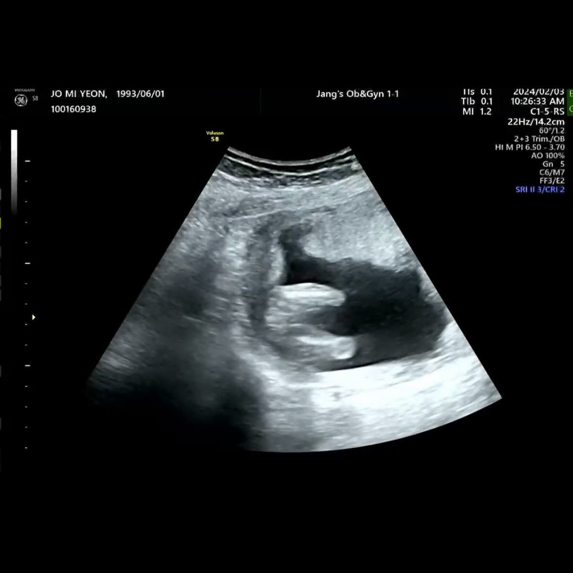 우리 땡글이는 땡순이공주님 확정 👶🏻🩷
세은이가 언니가 됬네 😆😆😆 
다들 바라던 셋째는 딸 ! 😊😊