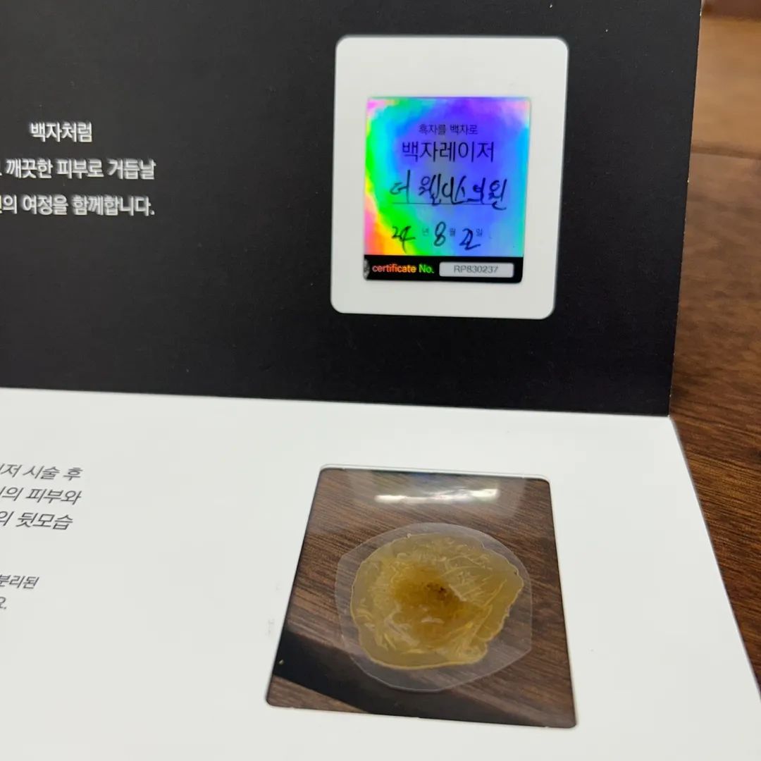 점점 기미도 하나둘 올라오고, 거뭇거뭇한 갈색 반점처럼 동그란 흑자까지 올라와서, 얼굴에 생긴 흑자를 제거 해주러 리팟레이저 제거 하러 다녀왔어요 
리팟레이저는 1회 만에 깔끔하게 없어지는 레이저인데
흑자제거의 경우 리팟레이저 1회 + 듀오덤 2주 부착을 하고 있어해요 듀오덤 2주부착후 뗴어내면 흑자도 같이 쏙하고 같이 떨어져나간답니다 !! 쏙하고 빠져나와 간편하답니다 현재 리팟레이저 캠페인 진행중이라 참여해보아요
.
#백자레이저 #리팟레이저 #리팟 #reepot #백자레이저캠페인 #백자캠페인 #흑자 #흑자제거 #흑자 #검버섯 #오타모반 #잡티 #잡티제거 #밀크반점 #밀크커피반점 #커피반점 #카페오래반점 #주근깨 #얼굴착색 #색소침착 #색소치료 #색소질환 #피부과 #피부과시술추천 #피부과시술 #피부관리