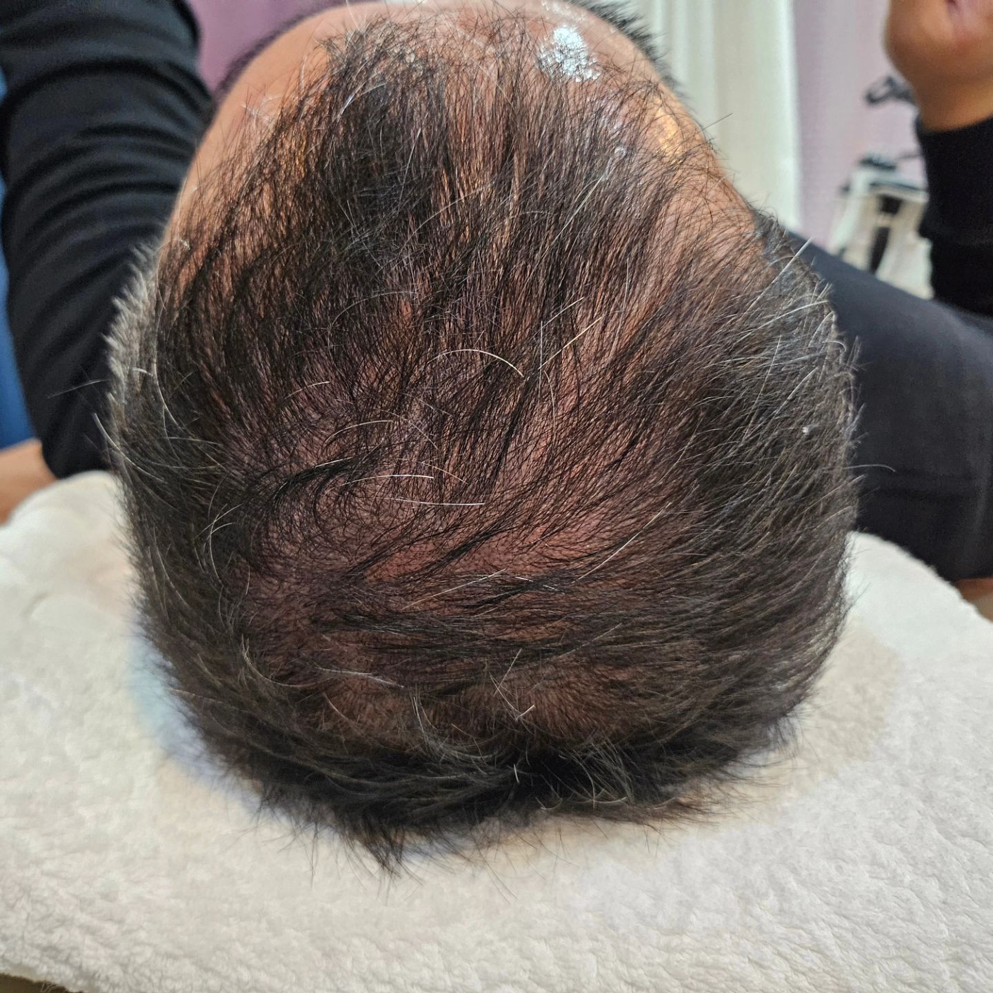 탈모 플라즈마안아파요!
페이스 플라즈마 할때 이마 부분 쏠때는 헤어라인 항상 
지나갔었고 , M자 이마 이신분들 특히 신경써서 했드랫죠 
근데 3-5회차  오실때 다시 보니까 솜털들이 뙇 😮

이게ㅡ모야 
솜털 바사삭 솓아오르고 있습니다 진짜 신기하게 솜털 올라와여 
대박이쥬 엄청납니다 

플라즈마 +탈모샴푸 같이 사용하시면 효과 더 좋겠죠 
두피 에센스 같이 쓰면 효과 더 좋겠죠!

약은 부작용이 너무 많고 약 안먹었을때 다시 빠진다고 
하더라구여 안전하게 플라즈마 하세요 

부작용 없고 간단하고 효과 좋잖아요 !

#플라즈마 #탈모 #두피케어 #두피관리  #송탄