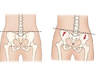 * 웨이트 트레이닝을 할 때 골반 컨트롤을 신경써야 하는 이유?

골반 불균형에는 3가지가 있습니다. 1) inflare/outflare 2) upslip/downship 3) 골반 회전성 불균형으로 나누어져 있습니다.

웨이트트레이닝을 할 때 골반 불균형을 골반 컨트롤을 해야 통증을 줄일 수 있습니다.

골반 틀어진 상태에서 골반 컨트롤을 하지 않고 웨이트 트레이닝을 하게 되면 운동초보자 경우에는 허리에 무리가 오거나 부상 경험을 느낄 수 있습니다.

또한 운동 중/상급자 또는 보디빌더 같은 경우 운동 타겟을 하는데 원하는 타겟을 받지 못해 어깨 불균형 및 찝힘 등 일어날 수 있으며 또한 대회 포징에서 원하는 포징이 나오지 않을 수 있습니다. 따라서 웨이트 트레이닝 할때 골반컨트롤에 신경써야 합니다.