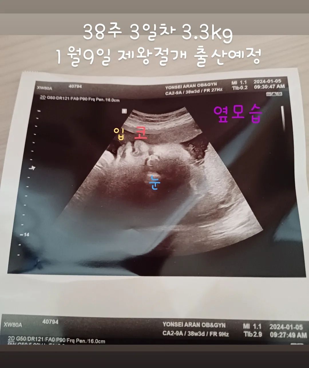 #출산임박 #38주3일 

오늘은 마지막 진료❤️

봄이 38주 3일차
몸무게 3.3kg
여아

예정일 1월16일
제왕절개예약 1월9일

몇일안남았네💜
다음주 화요일날은 무조건 빛을 보겠구나 !

이번주 무사히 지나가길~바라며

오늘도 역아 !
자연분만하고픈데.. 대각선으로 누워계신 공주님땜에
수술하네 😱😱😱

연우오빠는 39주때 3kg로 태어났는데
동생은..더 통통한가봄..🤭

#1월9일 #제왕절개 #예약 #임신 #출산 #육아
#만삭 #임신스타그램 #육아스타그램 #일상
#태아 #초음파사진 #좋아요 #육아맞팔 #예비맘