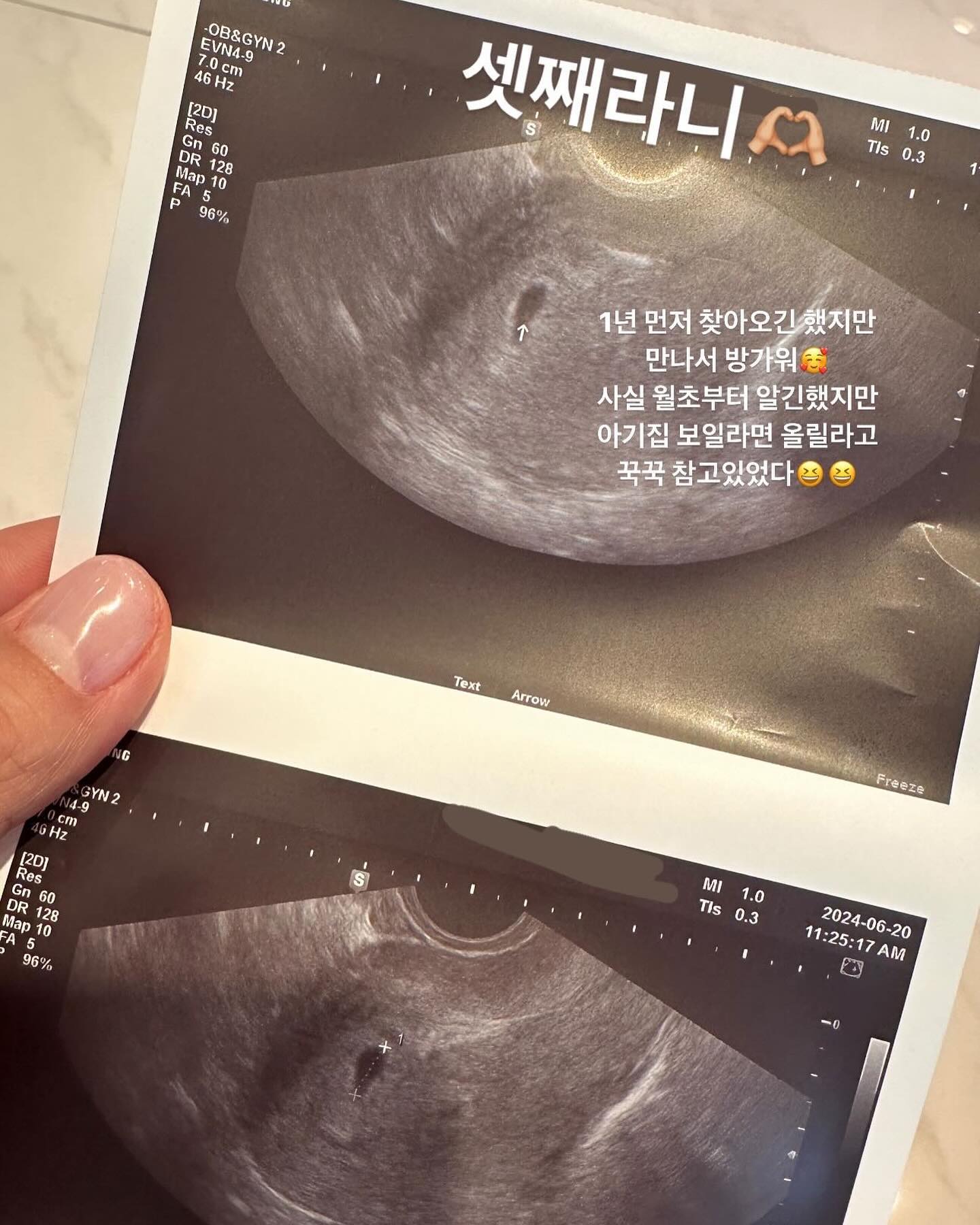 24.06.07
혹시몰라 얼리테스트기를 해봤던 날,
오전에는 나만 보이는 매직아이 두줄
오후에는 선명한 두 줄

유난히 내가 셋째를 원했고, 남편은 ,,, 단호박 놉 이였는데
셋째임신소식을 듣고도 무던한 반응ㅋㅋㅋㅋㅋ

저번주 수요일에 갔을때도 안보여줬던 아가인데
오늘 보러갔을때는 아가집으로 보여줬다
다다음주에는 심장소리 들으러갈게,💛

오늘 스토리 올린후, 굉장한 축하를 받았어요
너무 감사합니다💛

셋찌야
오래오래 잘 붙어있다가 건강하게 나와서
별이랑 우주랑 지지고볶고 싸우고 그러면서 커랏
잘때는 5명이서 잘거라 조금 낑기긴하겠지만,,,어쩌것슈?

셋찌 태명은 뭘로할지 모르겠어서 그냥 셋찌
뭐 좋은게 있을까요
별이한테 뱃속에 있을때 부를 이름 지어달라니 ‘여자’라고 부르라던디
ㅋㅋㅋㅋㅋㅋㅋㅋ

#임밍아웃 #벌써셋째 #다둥맘예약
#이제임신그만