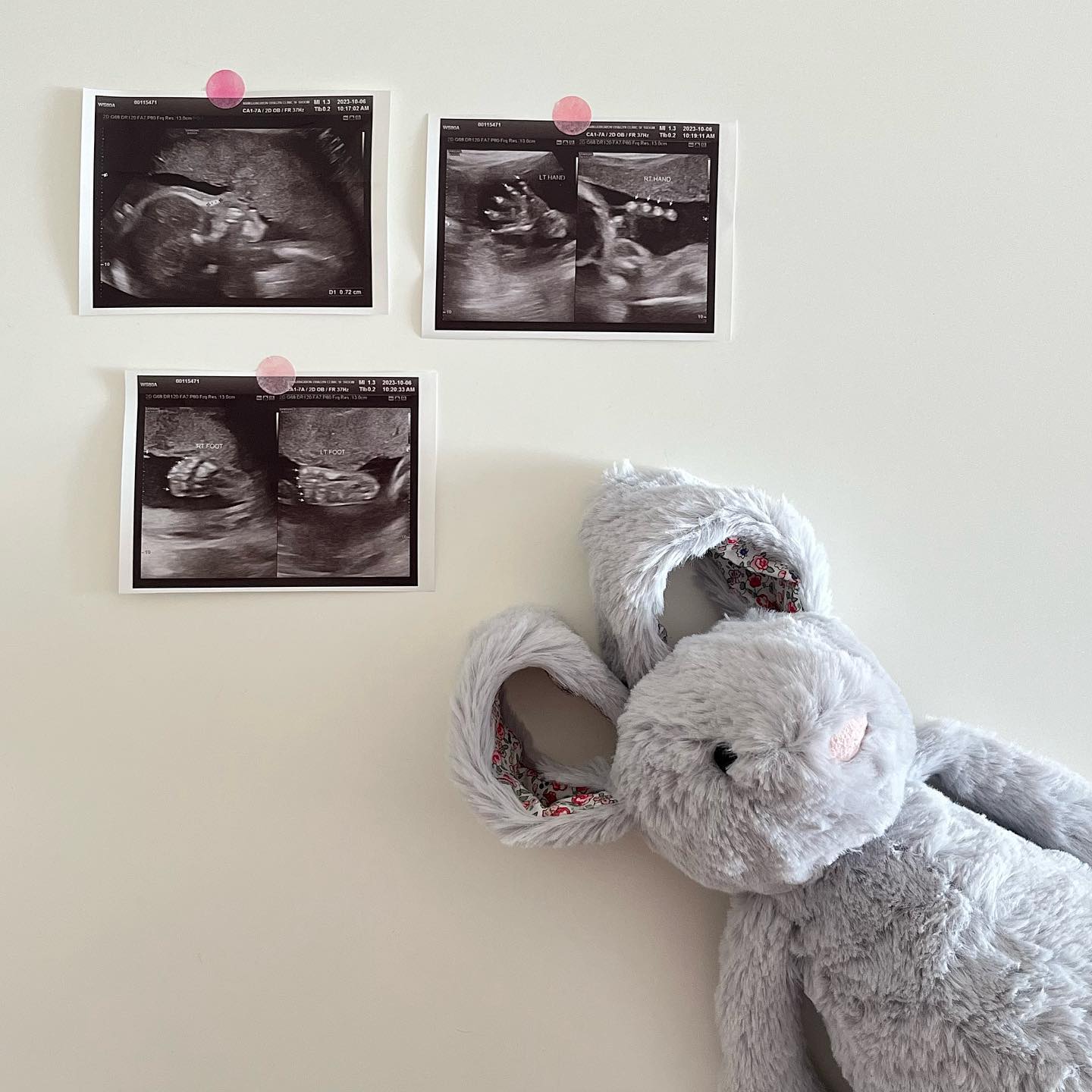 #24주👶🏻
정밀초음파&임당검사 모두 가볍게 통과!
건강한 깜짝이 덕분에 행복한 임신생활 ing~

고마워 울아가!

#깜짝이💖 #2024baby #7개월 #24주