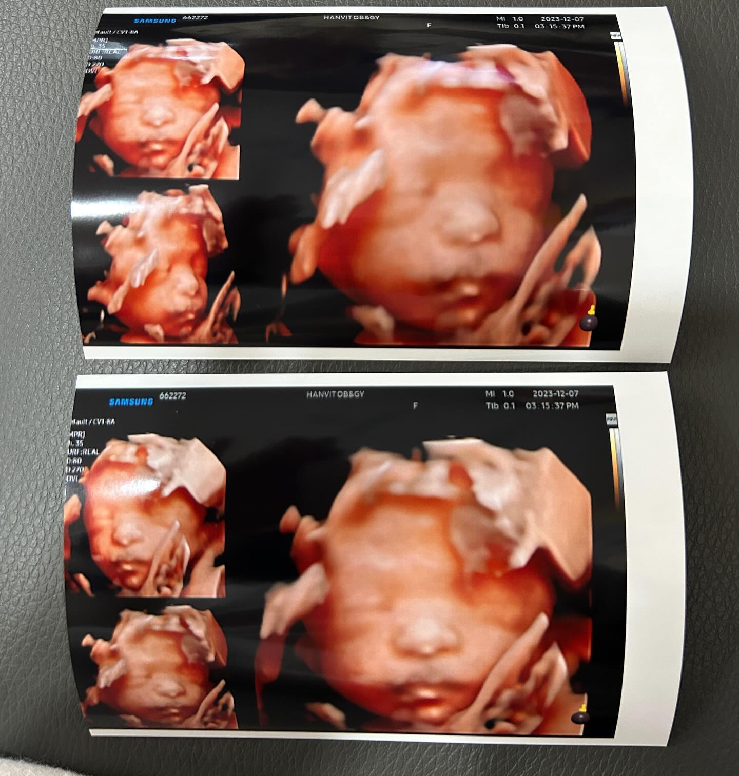 👶🏻카오일지 23.12.7💕

오늘 입체초음파 보고왔어욤🥰
유전자의 신비ㅎㅎㅎ~ 남편이랑 나랑 정말 닮았나...? 싶을정도로 서로 여긴 누구닮았다!! 하기가 어려운듯하다...😱

건강히 만나자 카오카오❤️‍🔥 
D-92