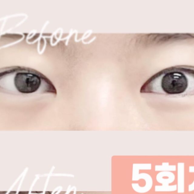  몽 MongMong on Instagram: "#광고 5번 침만 맞고 교정된 내눈🌝
(같은 힘을 주고 뜬 눈..)

1회차때만 해도 변화가 바로 느껴졌는데
5회차부터는 눈매가 생각보다 빨리 변화해
정말 놀랐다.

눈 뜨는 힘이 단기간에 강해져
전체적인 크기가 커 보이고

은근 게슴츠레했던 눈매를 또렷하게 해준
한방 눈매 비대칭 관리✨

10분정도 침 맞고 1시간만 누워 기다렸다가
거울을 보는 순간 오! 바로 느껴지는 변화에
금손 원장님을 또 또 찾아갈 수 밖에 없게 된다.

어떻게 침으로 이런 변화가 생길 수 있는지
아직도 믿기지 않고

유지기간 개념이 아닌 한번 한번의 교정이
노화로 내려오는 것 외엔
거의 영구적 교정이라

눈매로 고민인 분들께 강력 추천드리고 싶다.
✔️필요하신 분은 DM 후 방문시 할인 혜택이✔️

#한방케어 #안면비대칭 #안면비대칭교정 #대칭미인 #자연산대칭미인 #비대칭교정 #카메라성형 #쁘띠성형 #팔자주름 #팔자주름필러 #눈매교정 #눈썹교정 #볼살축소 #볼살교정 #윤곽관리 #얼굴윤곽관리 #신부관리 #턱관리 #광대관리 #얼굴축소 #한방관리 #아나운서얼굴관리 #연예인얼굴관리 #작은얼굴관리 #티안나는성형 #대칭교정"