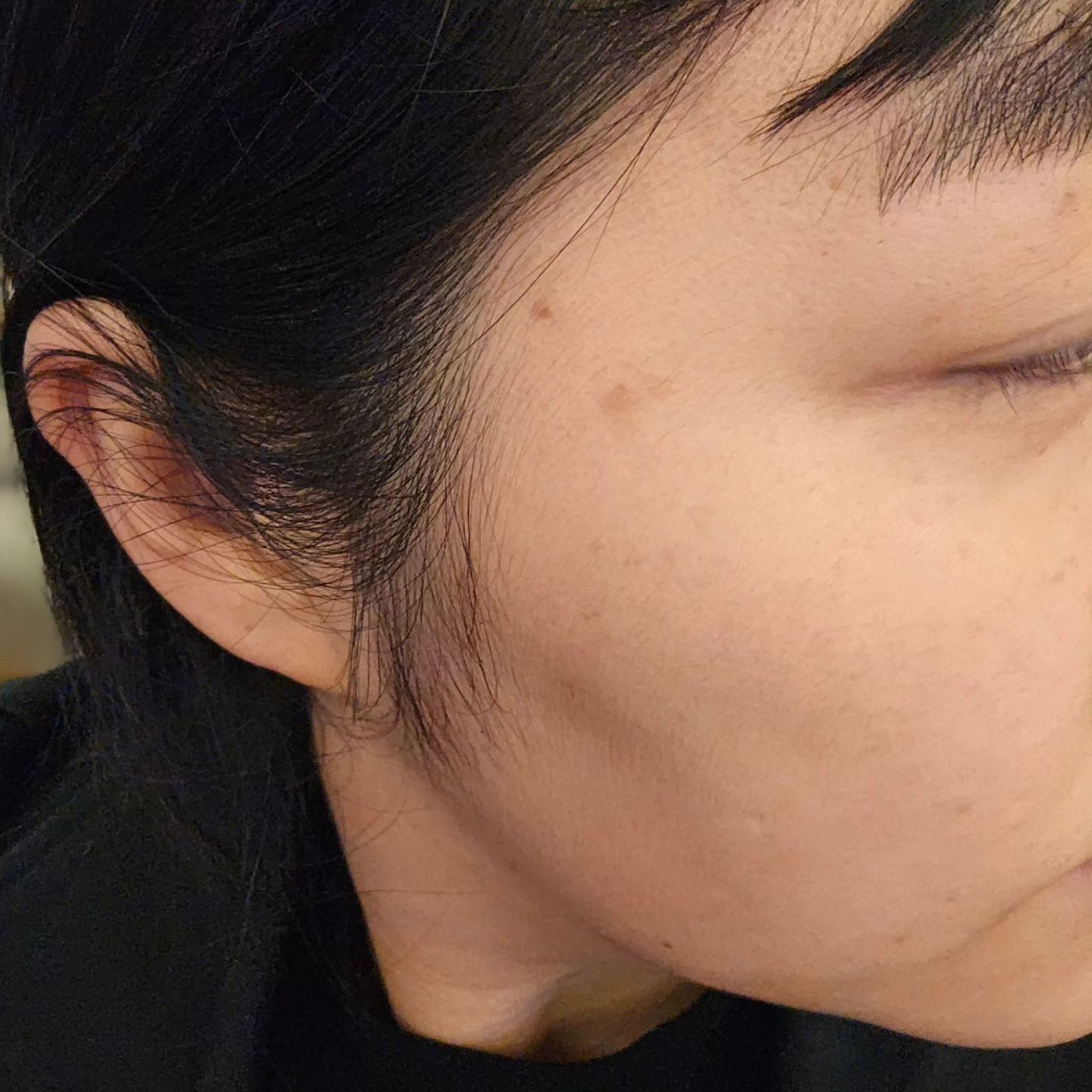 얼굴에 생긴 #흑자
언제 생겼는지도 모르게 생겼는데
이것때문에 외출할때마다
화장을 할려니 귀찮아
이번에 제대로 관리하기로 마음먹고
#리팟레이저 받고옴
.
리팟레이저는 흑자 제거 레이저로도 유명하기 때문에
예전부터 궁금했는데 이번에 큰 맘 먹고 흑자 제거를 위해
노원피부과에 방문!!

단 1~2회만으로 얼굴이나 바디 부위의 흑자, 검버섯 등
난치성 색소질환 제거가 가능하다고 하길래 
한번에 깔끔하게
흑자를 없어지는 것을 상상하며 완전기대중~
피부과 방문 후 상담 받고 시술에 들어갔는데 이게 무슨?
시술 시간이 1분도 채 안되서 오잉? 벌써 끝났나 ㅋㅋㅋ 싶어서 놀람.
레이저 시술인데 아픈 것도 모르겠고..?

리팟레이저는 색소 치료 타깃에만 레이저 에너지를 조사하는
위치 인식 및 추적 가이드 기술 Auto Derm을 적용하여 
정확하게 치료 병변에 맞춰 시술이 가능하다고 함.
아~~ 그래서 이렇게 쉽고 빠르게 끝이났군!

그리고 일반적으로 레이저 강도에 따른 시술 시 혈관 손상으로 인한 대표적인 부작용 ‘붉음증’ 또 다른 ‘색소침착’과 같은 현상이 발생되나 리팟레이저의 경우 이와 같은 부작용을 최소화 할 수 있도록 VSLS라는 기술이 설정되어 있다고 함.

완전 믿음직~

.
시술 후 듀오덤을 붙이고
2주동안 잘 붙이고 있어야 한다고 신신당부 하시는 원장님.
2주 뒤면 백자처럼 깨끗해질 피부가 되겠지 ㅎㅎ?
 
2주뒤가 궁금한 나! 없어져라 없어져라~
나의 흑자 피부고민 ..이젠 리팟레이저 덕에 안하는걸루ㅋ

#노원피부과 #백자레이저 #리팟레이저 #리팟백자레이저 #reepot #리팟 #흑자
#흑자고민 #피부얼룩덜룩 #흑자제거 #흑자레이저 #흑자없애는법 ##레이저시술 #레이저추천