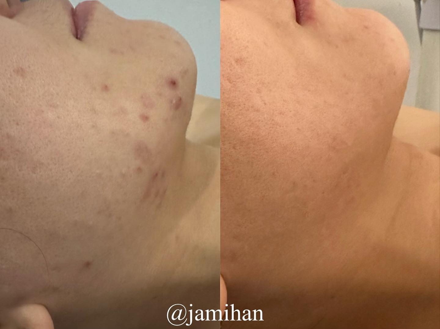 턱드름만 없어져도 살 거 같아요 하셨어요 🥲
지속되는 턱드름에 스트레스 .. 제가 싹 날려주었습니다
바쁜 일상 속 일하고 육아하는 시간에 저한테 오는 시간이
힐링하는 시간이라고 해주시는 우리 이쁜 고객님
저한테 와주셔서 감사합니다❤️